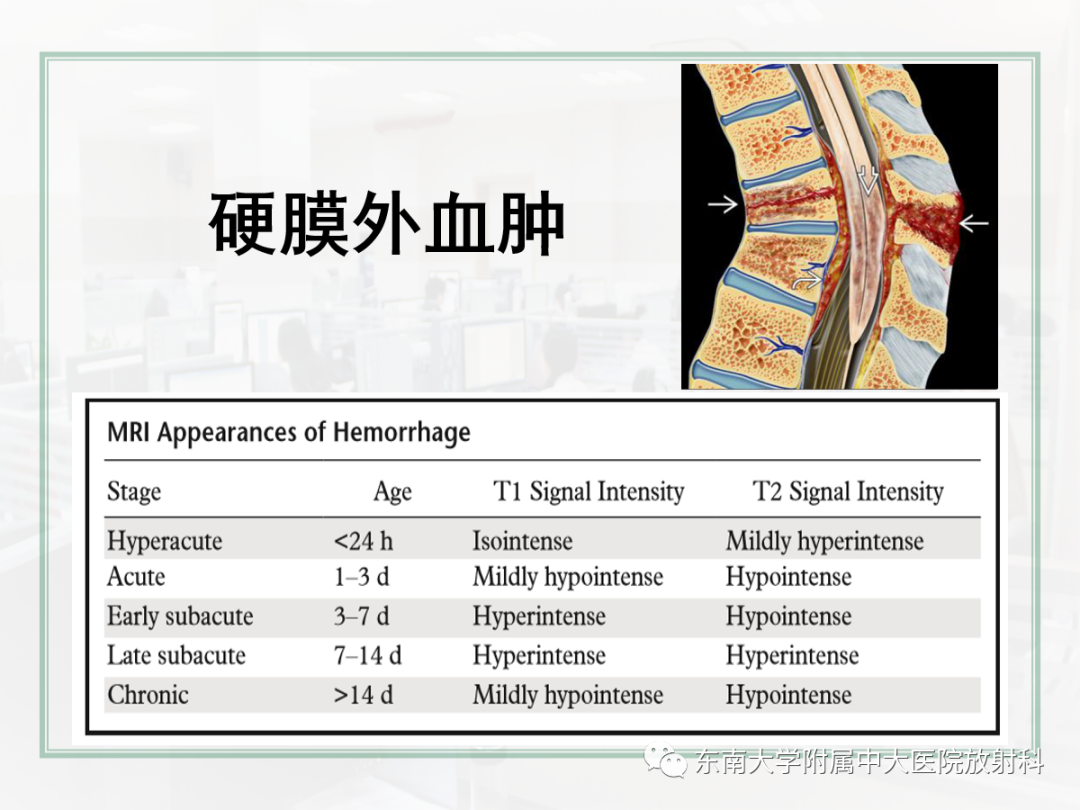 影像PPT - 【PPT】椎管内硬膜外间隙病变影像诊断思路-22