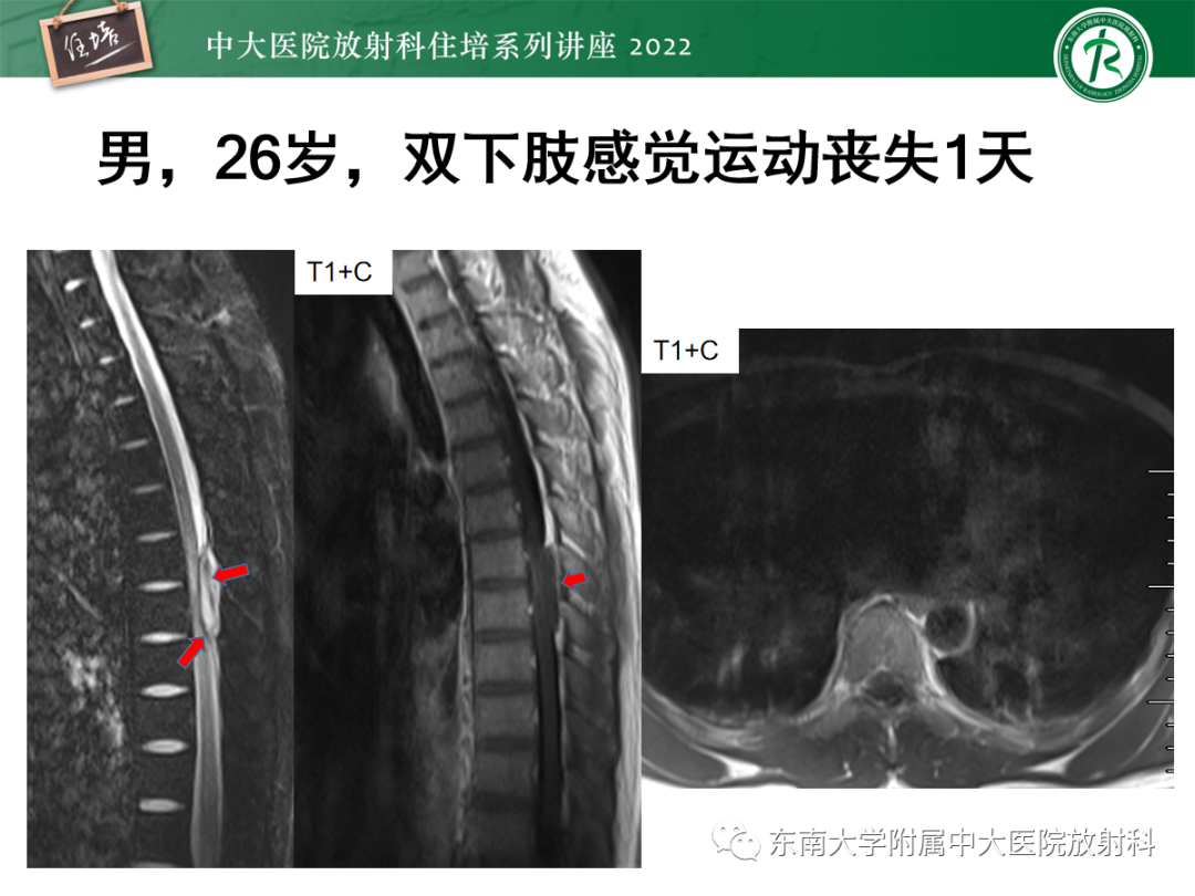 影像PPT - 【PPT】椎管内硬膜外间隙病变影像诊断思路-26