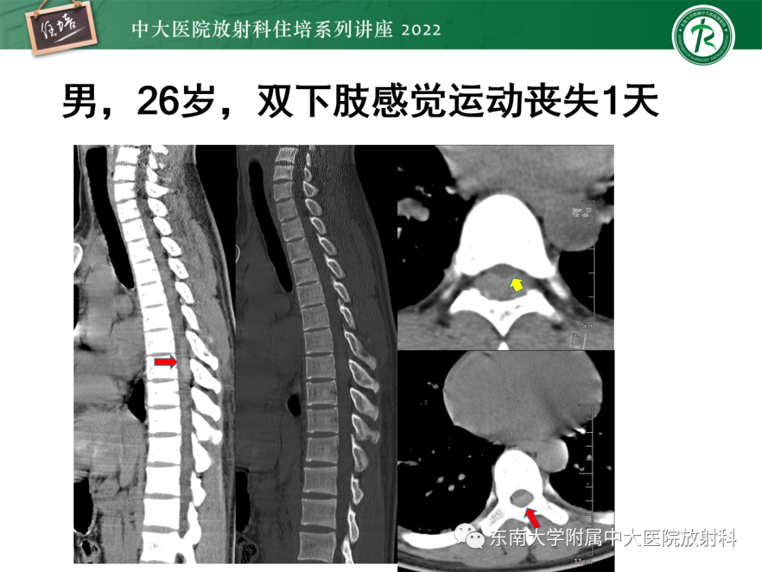 影像PPT - 【PPT】椎管内硬膜外间隙病变影像诊断思路-25