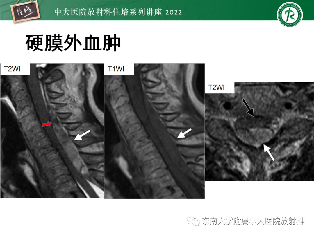 影像PPT - 【PPT】椎管内硬膜外间隙病变影像诊断思路-28