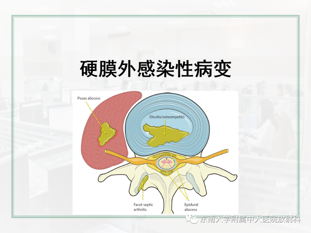 影像PPT - 【PPT】椎管内硬膜外间隙病变影像诊断思路-29