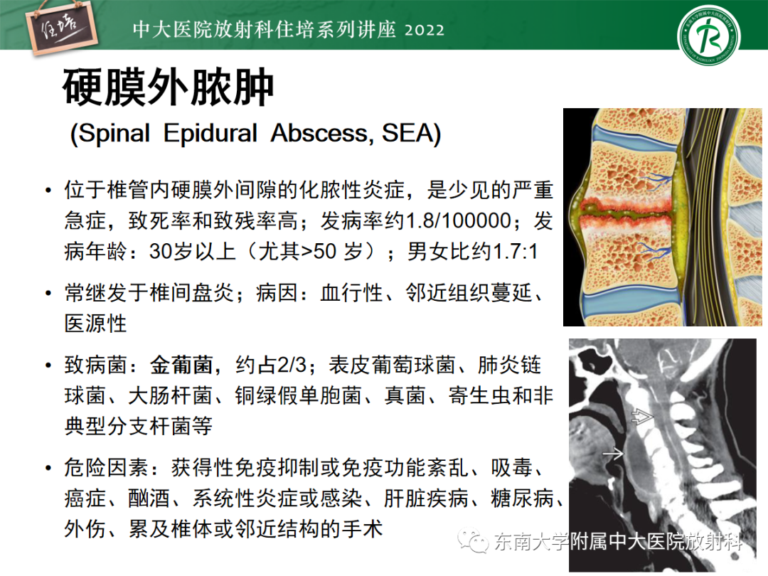 影像PPT - 【PPT】椎管内硬膜外间隙病变影像诊断思路-30