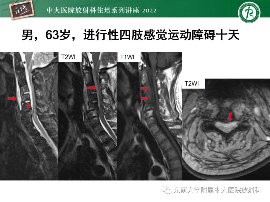 影像PPT - 【PPT】椎管内硬膜外间隙病变影像诊断思路-33