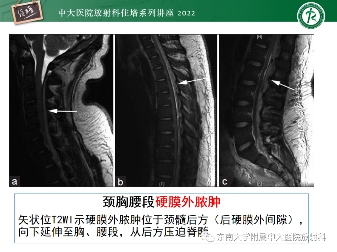 影像PPT - 【PPT】椎管内硬膜外间隙病变影像诊断思路-35