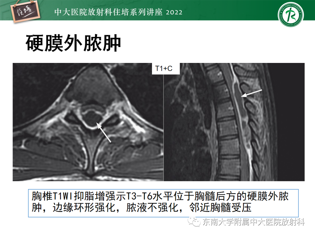影像PPT - 【PPT】椎管内硬膜外间隙病变影像诊断思路-36