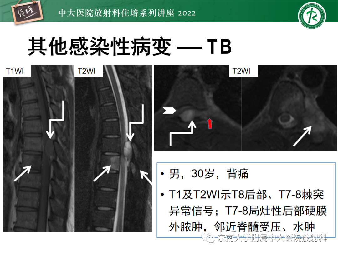 影像PPT - 【PPT】椎管内硬膜外间隙病变影像诊断思路-39