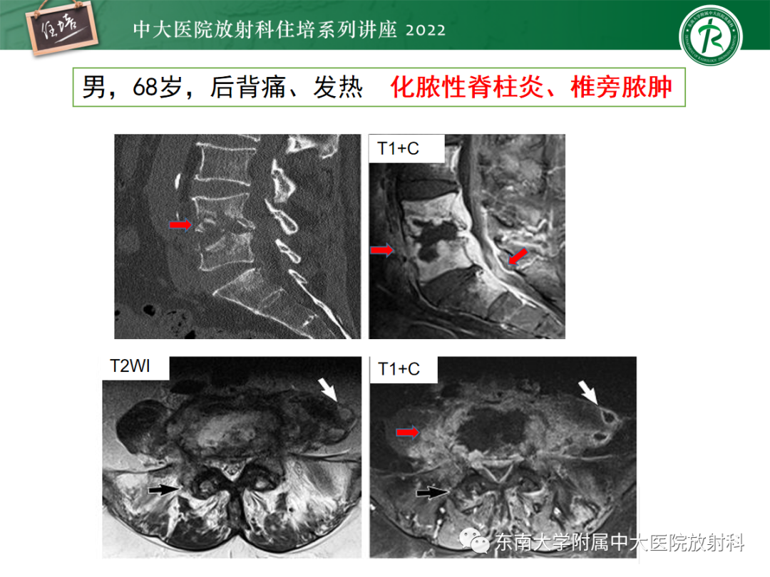 影像PPT - 【PPT】椎管内硬膜外间隙病变影像诊断思路-37