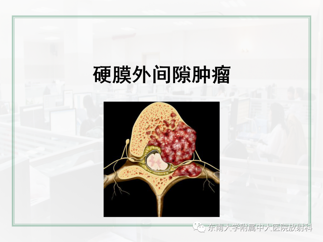 影像PPT - 【PPT】椎管内硬膜外间隙病变影像诊断思路-40