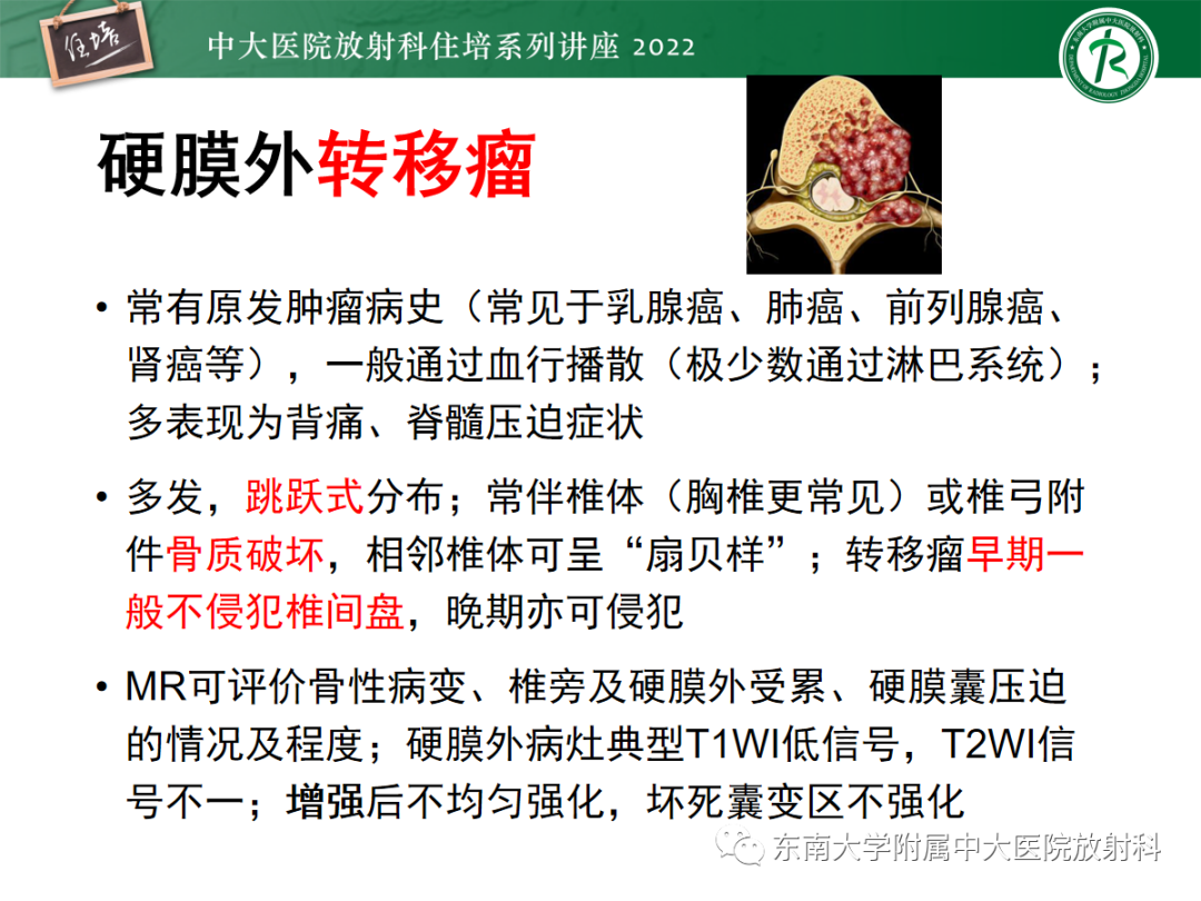 影像PPT - 【PPT】椎管内硬膜外间隙病变影像诊断思路-41