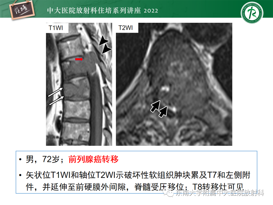 影像PPT - 【PPT】椎管内硬膜外间隙病变影像诊断思路-42