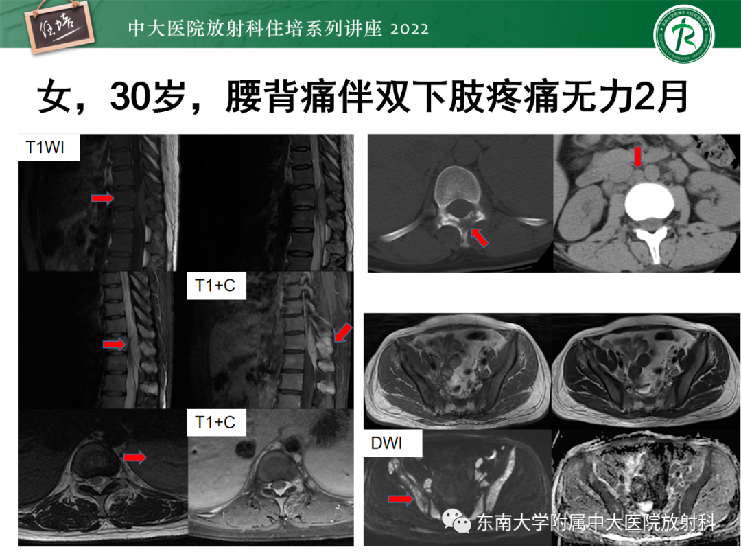 影像PPT - 【PPT】椎管内硬膜外间隙病变影像诊断思路-45