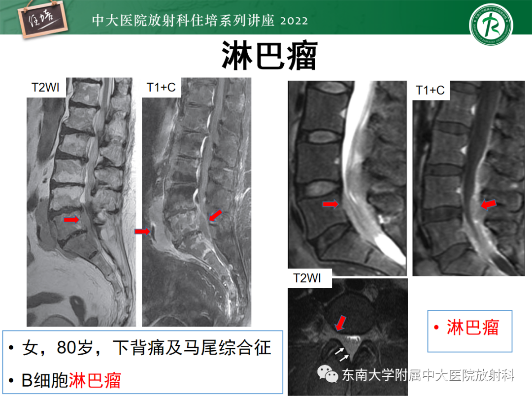 影像PPT - 【PPT】椎管内硬膜外间隙病变影像诊断思路-46
