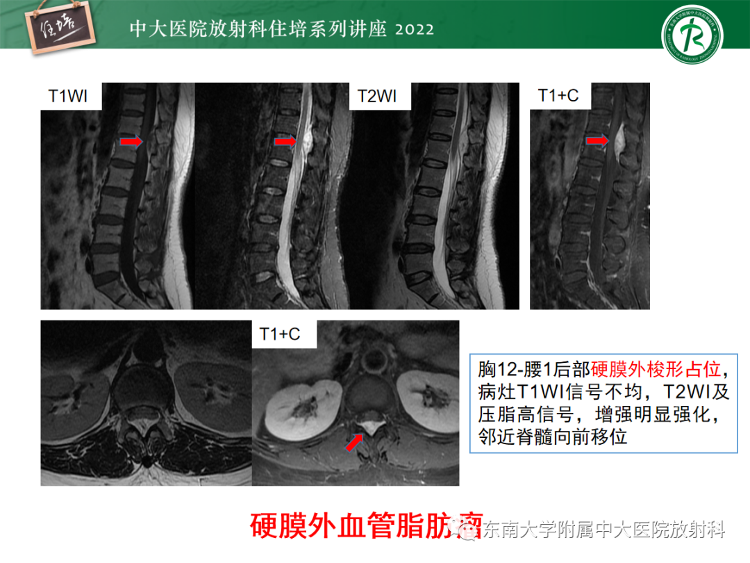 影像PPT - 【PPT】椎管内硬膜外间隙病变影像诊断思路-49