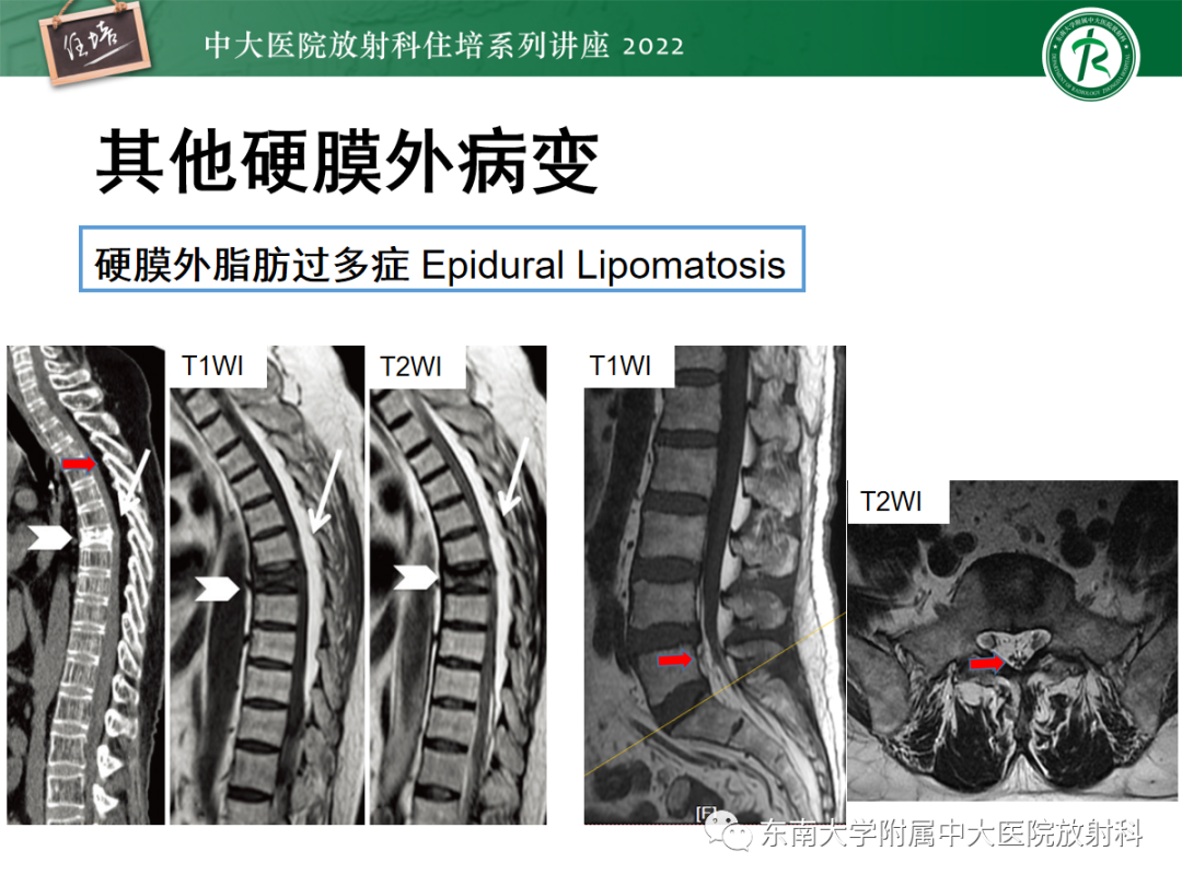 影像PPT - 【PPT】椎管内硬膜外间隙病变影像诊断思路-51