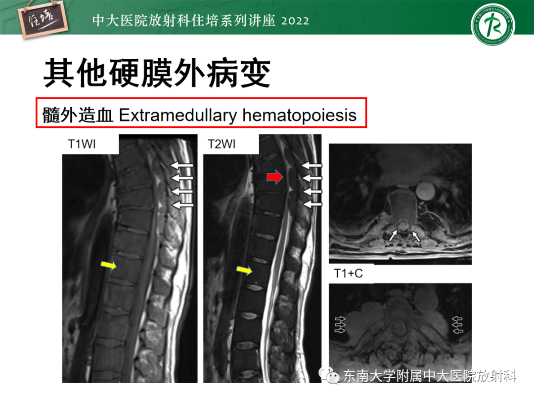 影像PPT - 【PPT】椎管内硬膜外间隙病变影像诊断思路-52