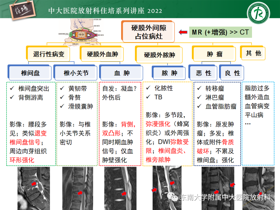 影像PPT - 【PPT】椎管内硬膜外间隙病变影像诊断思路-53