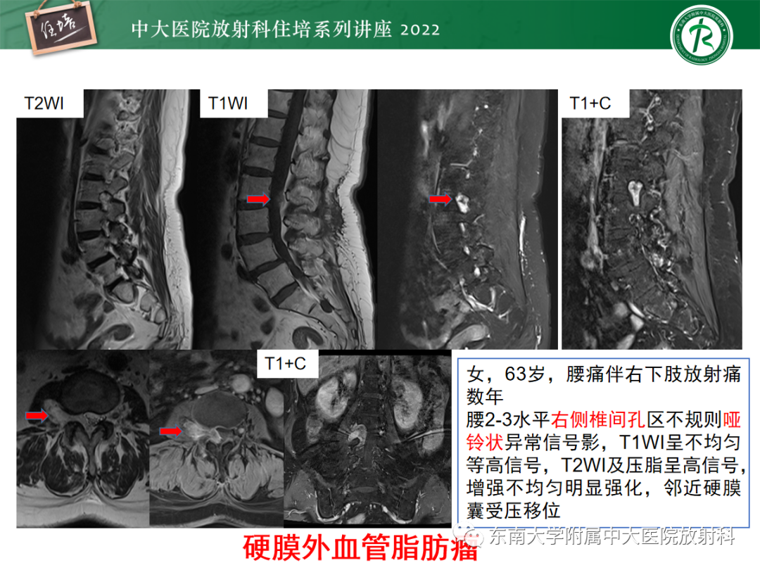 影像PPT - 【PPT】椎管内硬膜外间隙病变影像诊断思路-50