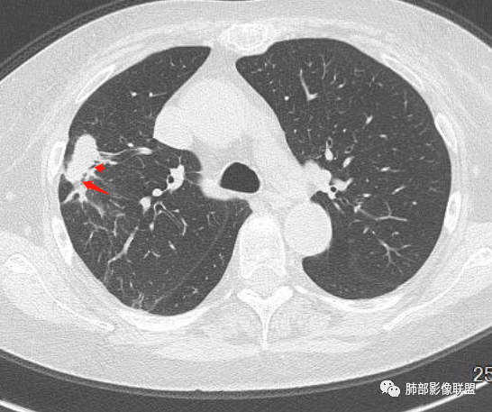 影像PPT - 【每日晨读】典型的胸膜下病变—隐球菌肺炎-54 影像PPT - 【每日晨读】典型的胸膜下病变—隐球菌肺炎-54