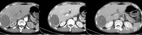 影像PPT - 胆管细胞癌-10 影像PPT - 胆管细胞癌-10