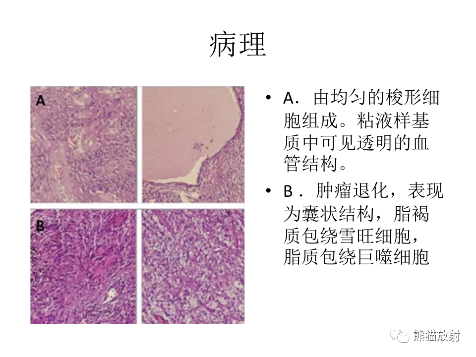 影像PPT - 【病例】胸壁神经鞘瘤2例CT影像-23