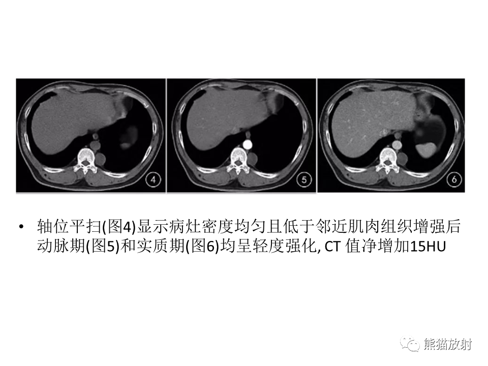 影像PPT - 【病例】胸壁神经鞘瘤2例CT影像-30