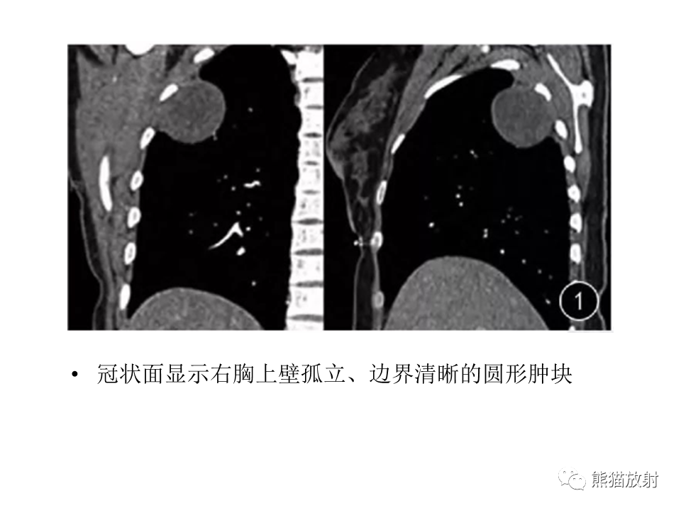 影像PPT - 【病例】胸壁神经鞘瘤2例CT影像-29