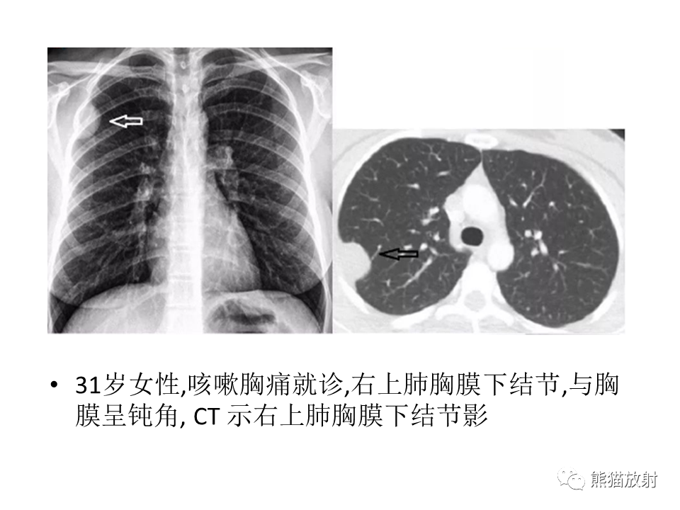 影像PPT - 【病例】胸壁神经鞘瘤2例CT影像-31