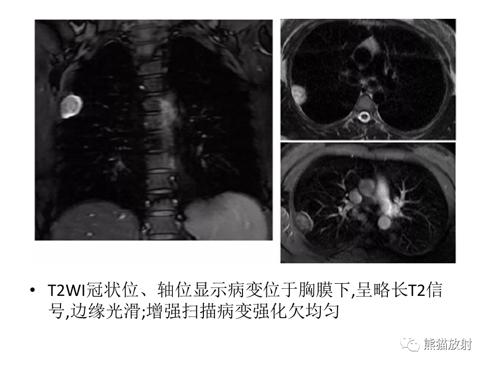影像PPT - 【病例】胸壁神经鞘瘤2例CT影像-32