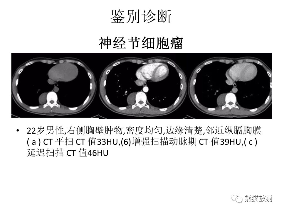 影像PPT - 【病例】胸壁神经鞘瘤2例CT影像-35