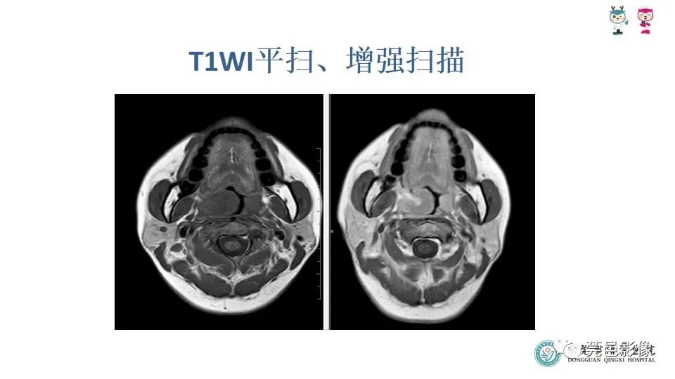 影像PPT - 【PPT】扁桃体淋巴瘤的影像诊断-5