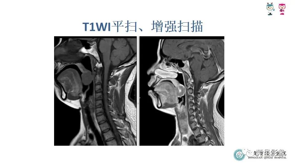 影像PPT - 【PPT】扁桃体淋巴瘤的影像诊断-6