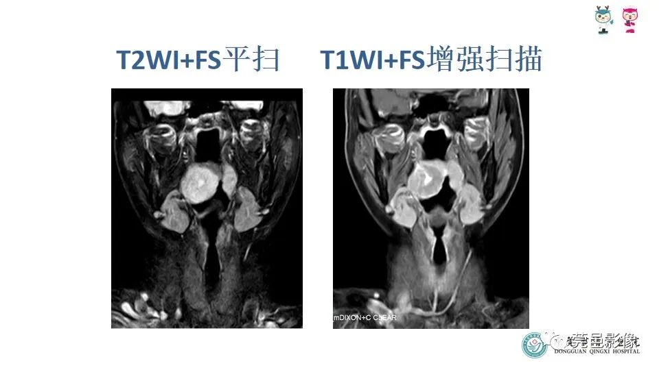 影像PPT - 【PPT】扁桃体淋巴瘤的影像诊断-7