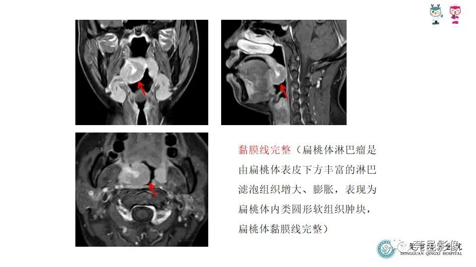 影像PPT - 【PPT】扁桃体淋巴瘤的影像诊断-18