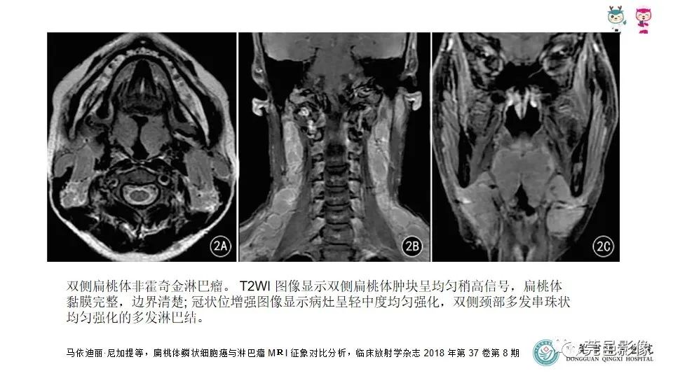 影像PPT - 【PPT】扁桃体淋巴瘤的影像诊断-19