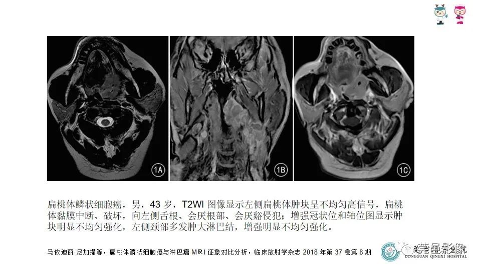影像PPT - 【PPT】扁桃体淋巴瘤的影像诊断-22