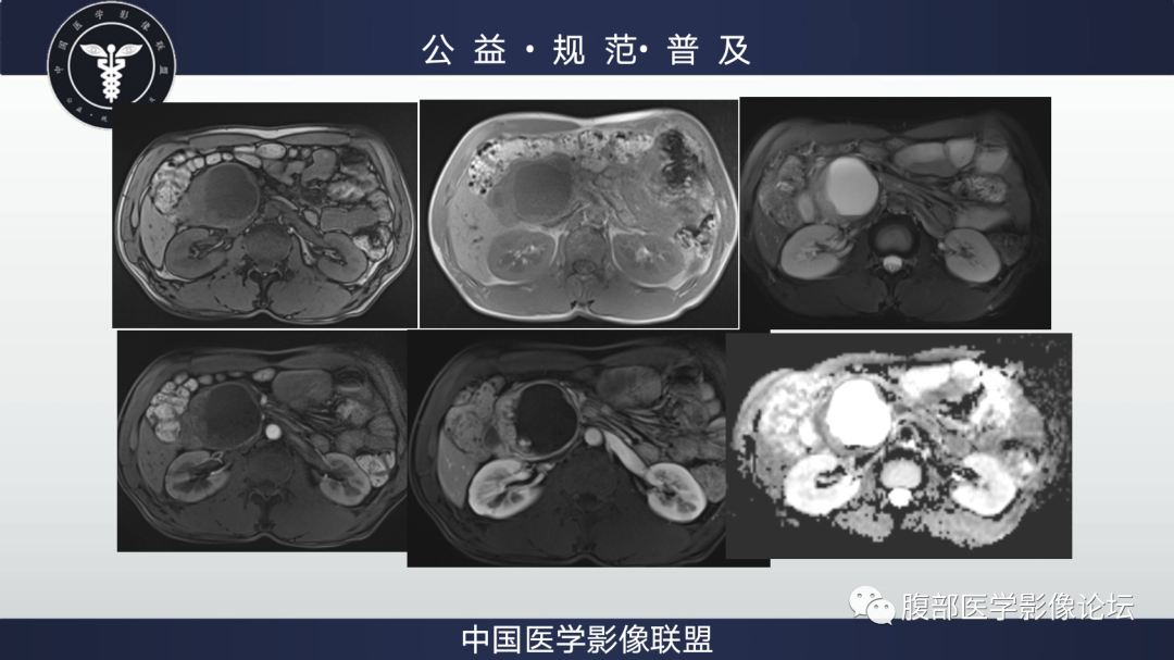 影像PPT - 【病例】胰腺神经内分泌肿瘤肝转移1例CT及MR-4
