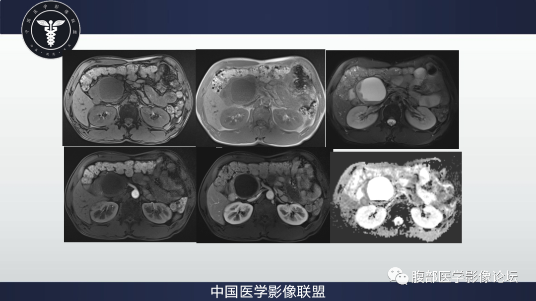 影像PPT - 【病例】胰腺神经内分泌肿瘤肝转移1例CT及MR-3