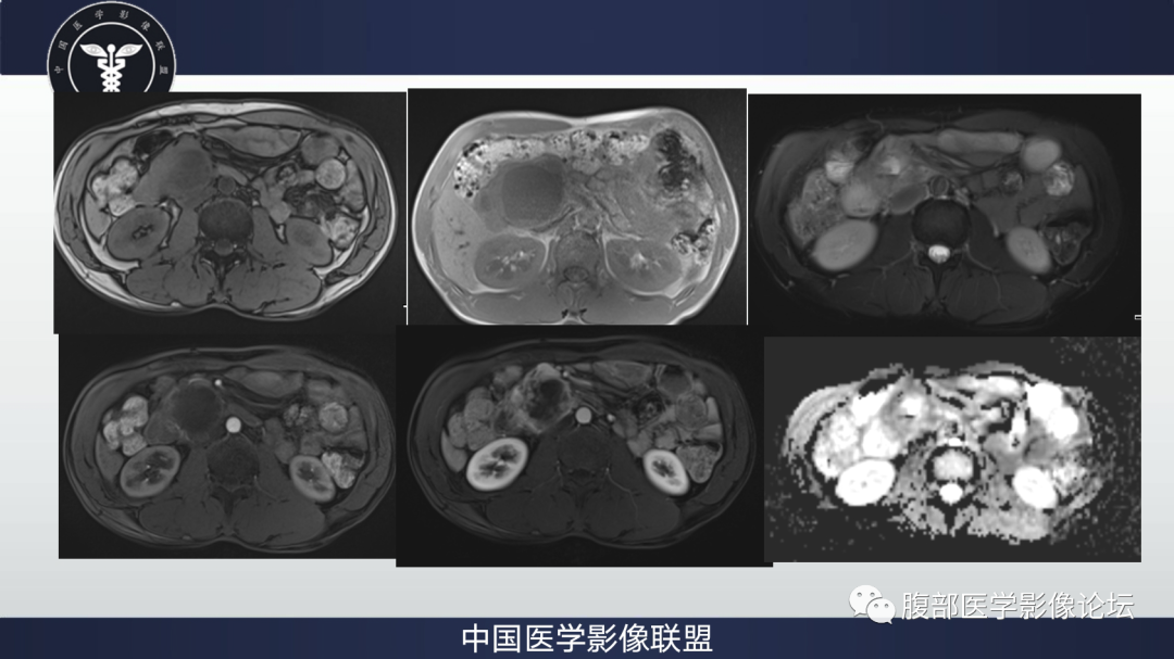 影像PPT - 【病例】胰腺神经内分泌肿瘤肝转移1例CT及MR-5