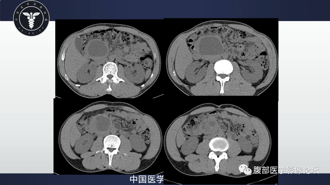 影像PPT - 【病例】胰腺神经内分泌肿瘤肝转移1例CT及MR-6