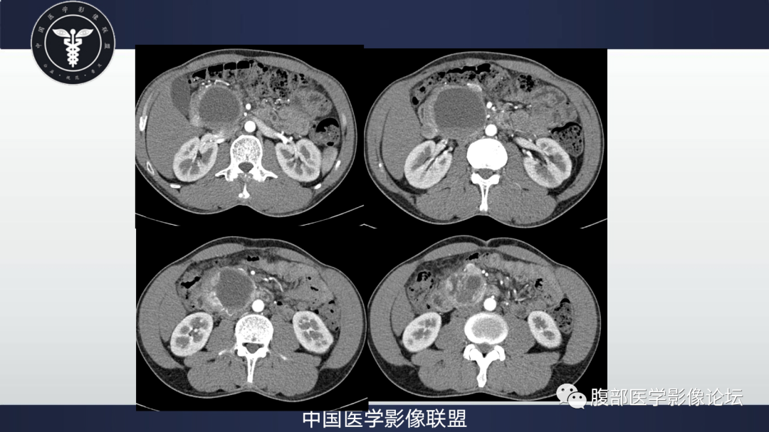 影像PPT - 【病例】胰腺神经内分泌肿瘤肝转移1例CT及MR-7