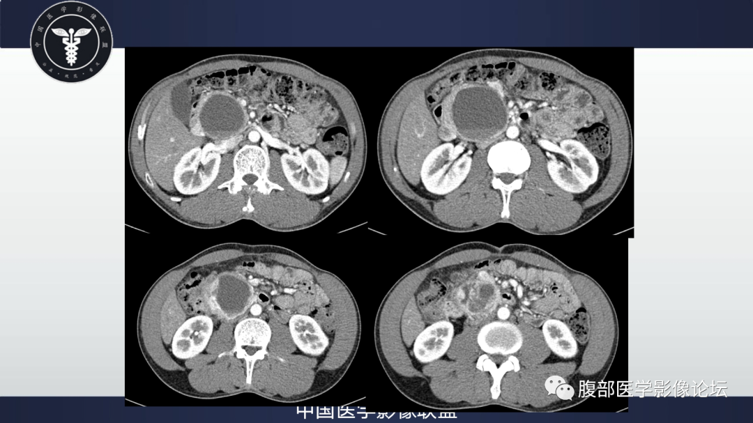 影像PPT - 【病例】胰腺神经内分泌肿瘤肝转移1例CT及MR-8