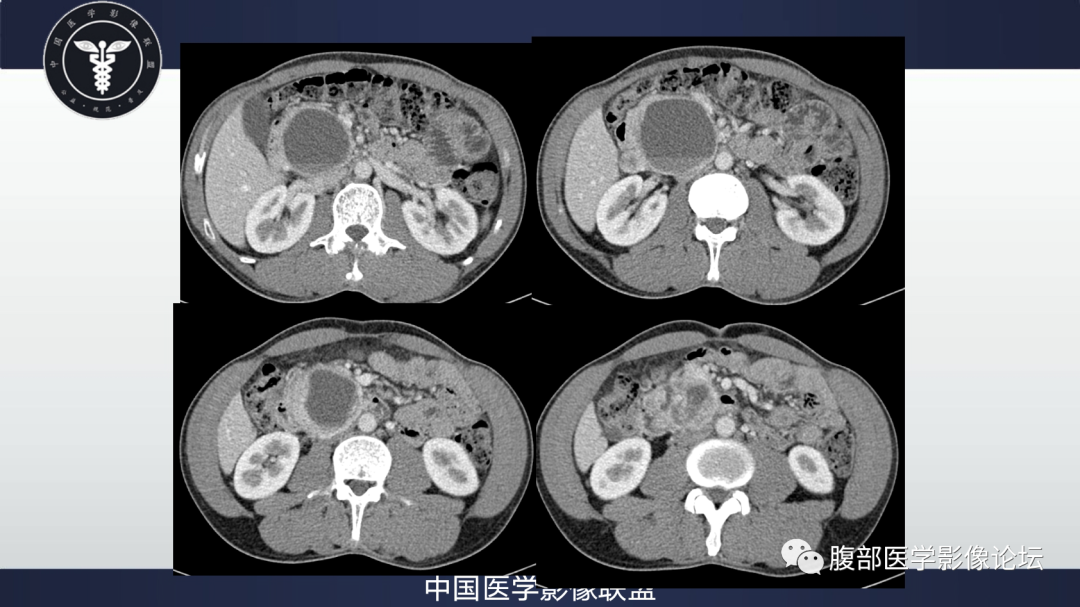 影像PPT - 【病例】胰腺神经内分泌肿瘤肝转移1例CT及MR-9