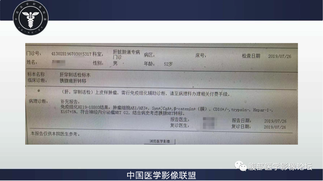 影像PPT - 【病例】胰腺神经内分泌肿瘤肝转移1例CT及MR-10