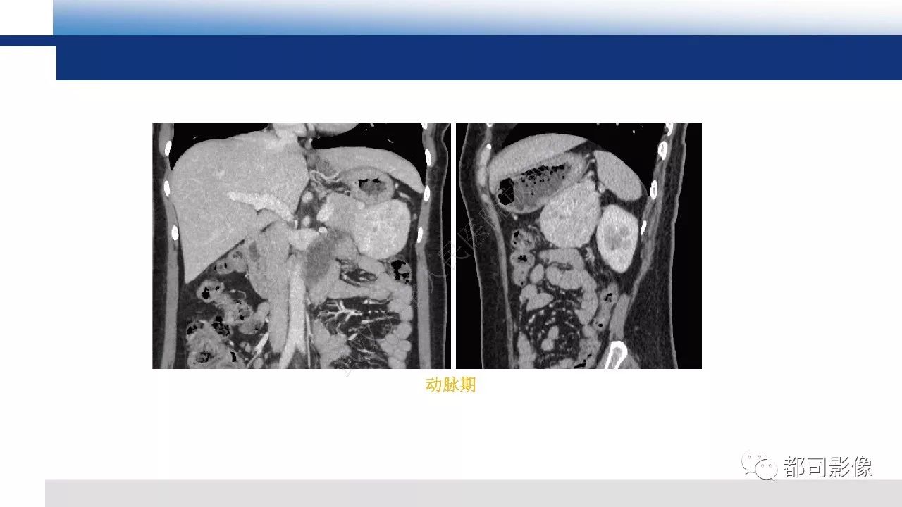 影像PPT - 【病例】胰腺神经内分泌肿瘤肝转移1例CT及MR-15