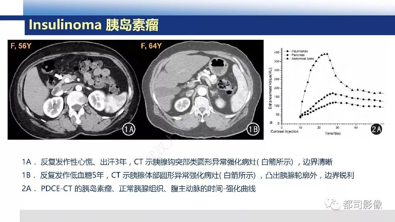 影像PPT - 【病例】胰腺神经内分泌肿瘤肝转移1例CT及MR-25