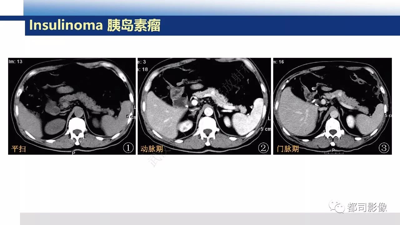 影像PPT - 【病例】胰腺神经内分泌肿瘤肝转移1例CT及MR-26