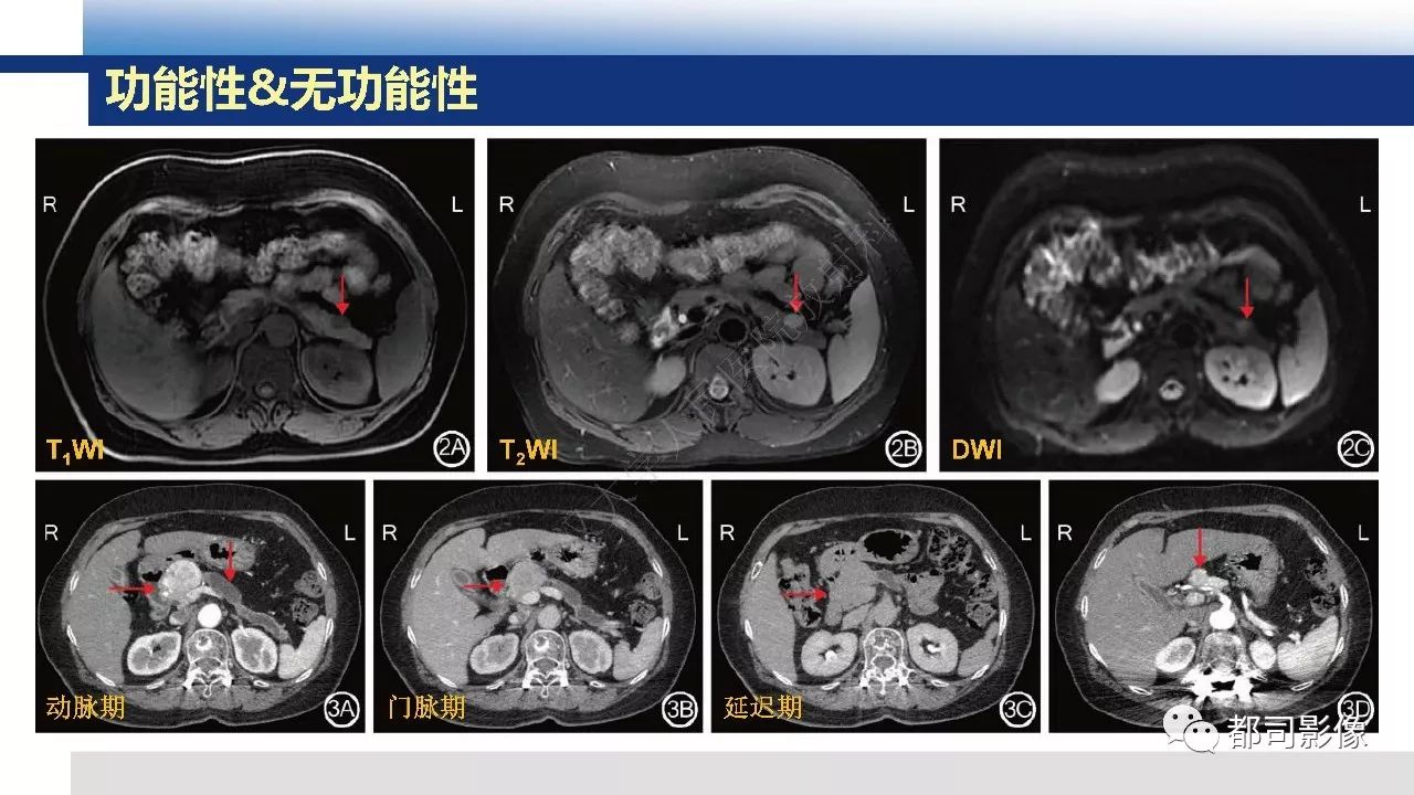 影像PPT - 【病例】胰腺神经内分泌肿瘤肝转移1例CT及MR-27