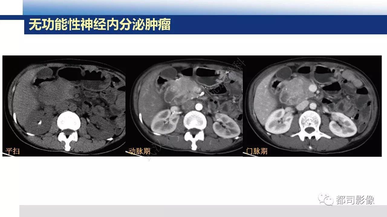 影像PPT - 【病例】胰腺神经内分泌肿瘤肝转移1例CT及MR-28