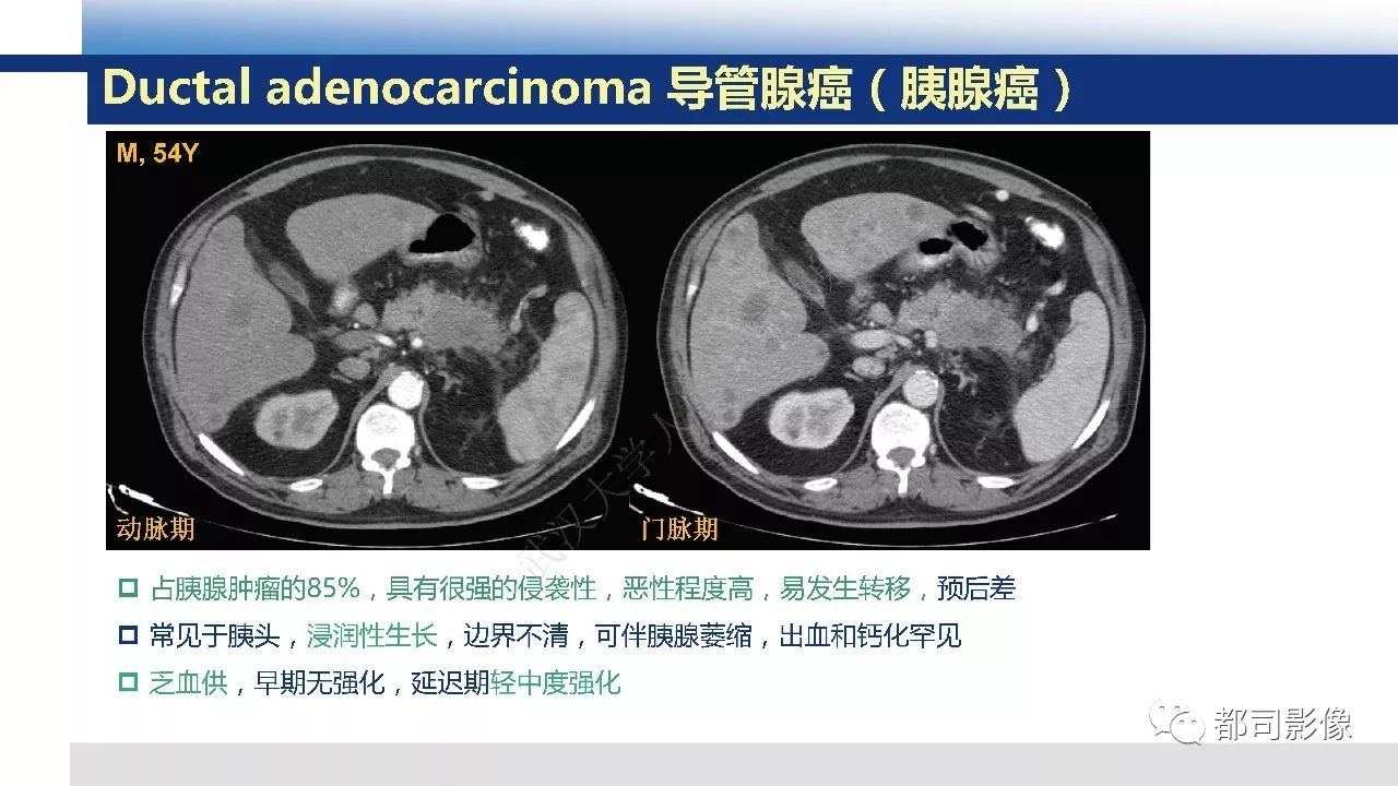 影像PPT - 【病例】胰腺神经内分泌肿瘤肝转移1例CT及MR-31