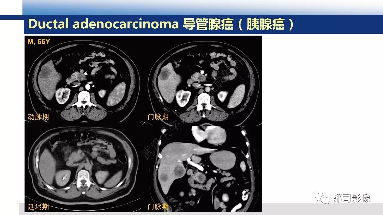 影像PPT - 【病例】胰腺神经内分泌肿瘤肝转移1例CT及MR-32